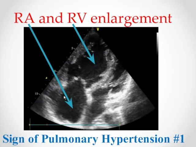 RA and RV enlargement Sign of Pulmonary Hypertension #1