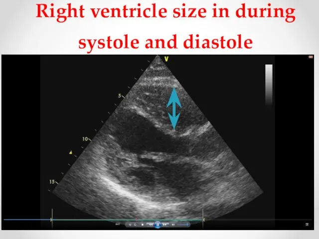 Right ventricle size in during systole and diastole