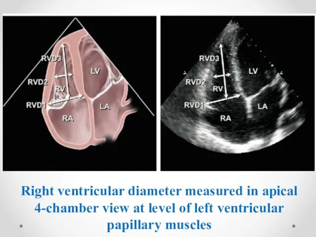 Right ventricular diameter measured in apical 4-chamber view at level of left ventricular papillary muscles