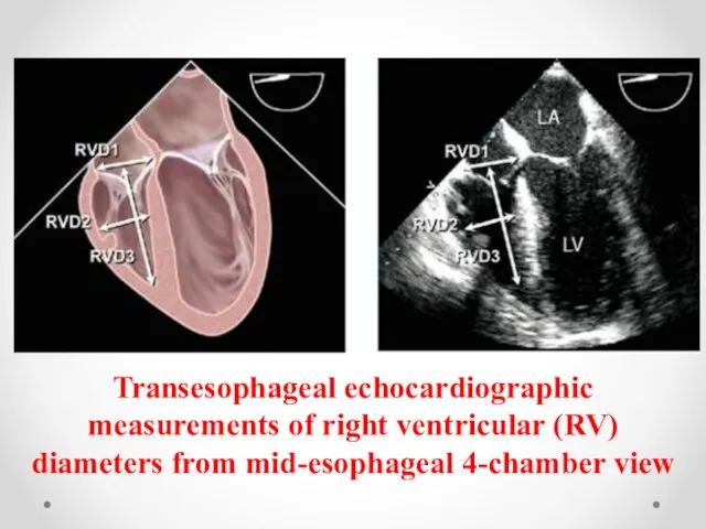 Transesophageal echocardiographic measurements of right ventricular (RV) diameters from mid-esophageal 4-chamber view