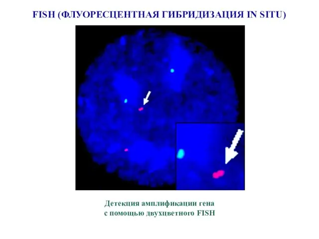 FISH (ФЛУОРЕСЦЕНТНАЯ ГИБРИДИЗАЦИЯ IN SITU) Детекция амплификации гена с помощью двухцветного FISH