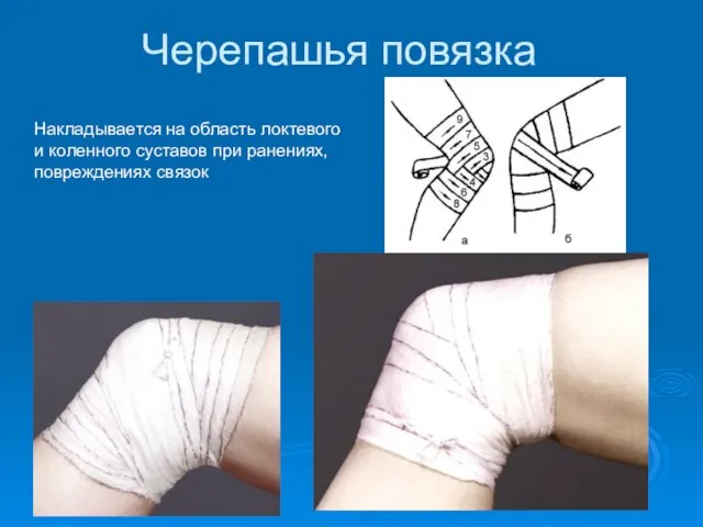 Черепашья повязка Накладывается на область локтевого и коленного суставов при ранениях, повреждениях связок