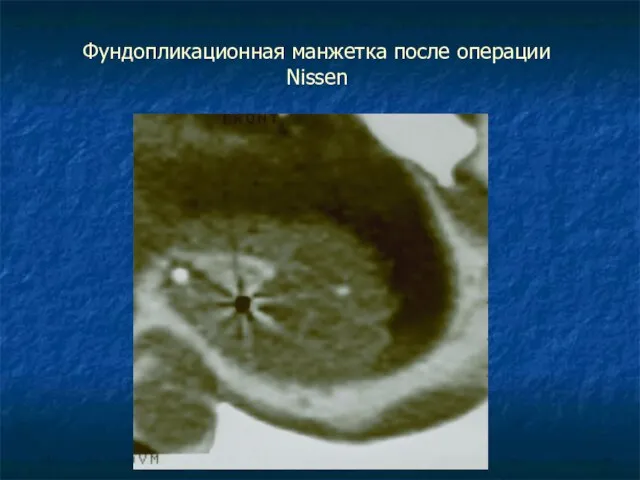 Фундопликационная манжетка после операции Nissen