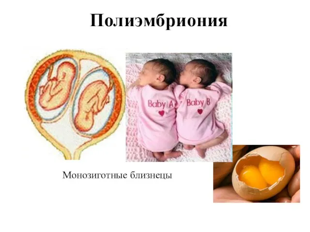 Полиэмбриония Монозиготные близнецы