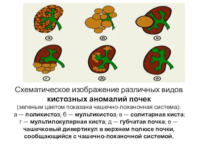 Схематическое изображение различных видов кистозных аномалий почек (зеленым цветом показана чашечно-лоханочная