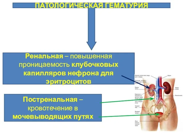 ПАТОЛОГИЧЕСКАЯ ГЕМАТУРИЯ Ренальная – повышенная проницаемость клубочковых капилляров нефрона для эритроцитов