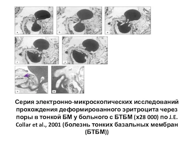 Серия электронно-микроскопических исследований прохождения деформированного эритроцита через поры в тонкой БМ