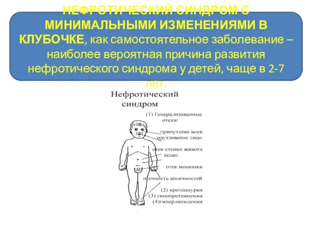 НЕФРОТИЧЕСКИЙ СИНДРОМ С МИНИМАЛЬНЫМИ ИЗМЕНЕНИЯМИ В КЛУБОЧКЕ, как самостоятельное заболевание –