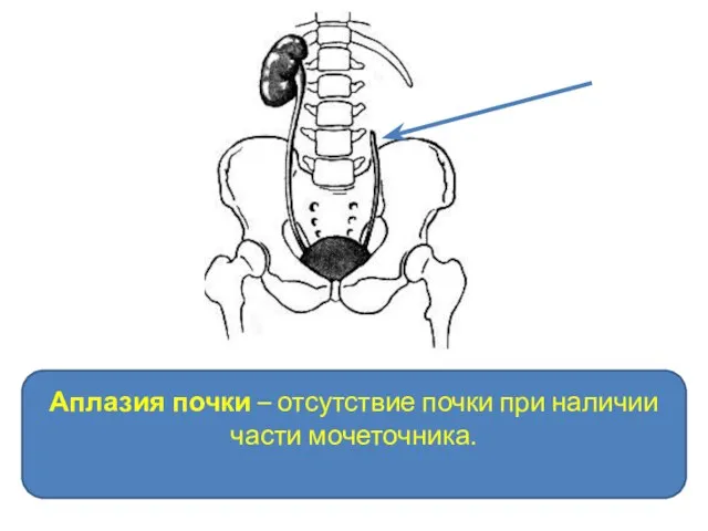 Аплазия почки – отсутствие почки при наличии части мочеточника.