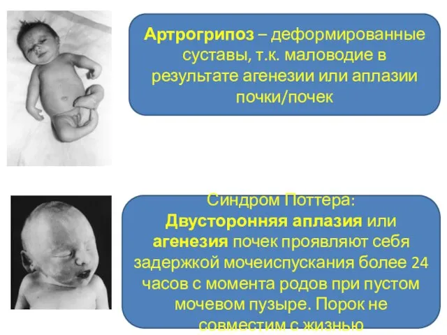 Артрогрипоз – деформированные суставы, т.к. маловодие в результате агенезии или аплазии