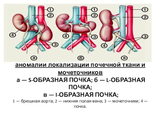 аномалии локализации почечной ткани и мочеточников а — S-ОБРАЗНАЯ ПОЧКА; б