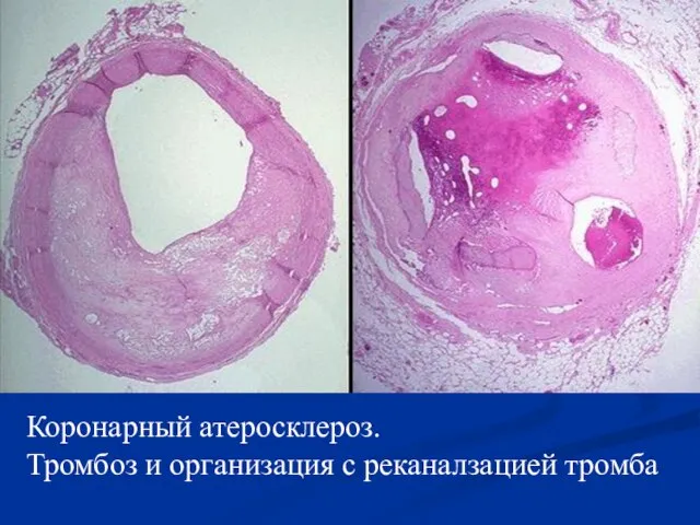 Коронарный атеросклероз. Тромбоз и организация с реканалзацией тромба