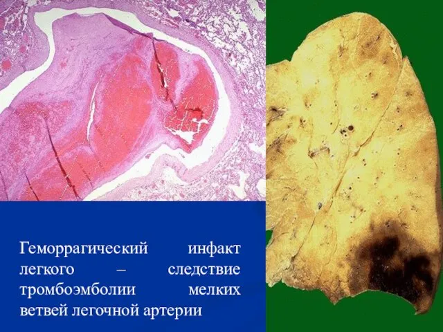 Геморрагический инфакт легкого – следствие тромбоэмболии мелких ветвей легочной артерии