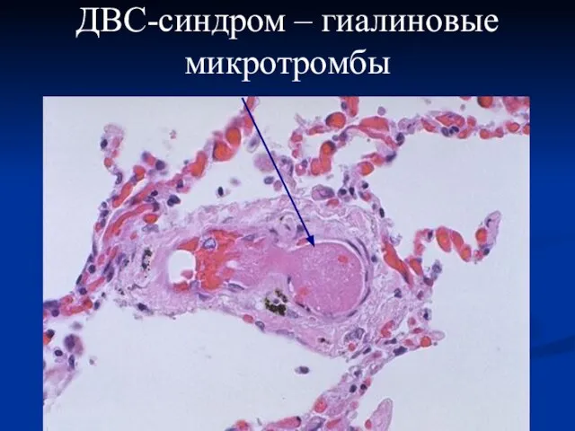 ДВС-синдром – гиалиновые микротромбы