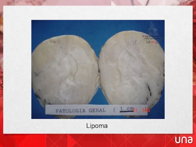 Lipoma