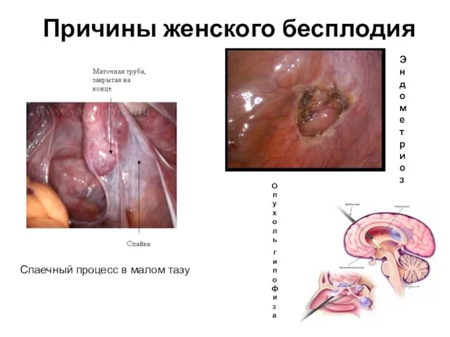 Причины женского бесплодия Опухоль гипофиза Эндометриоз Спаечный процесс в малом тазу