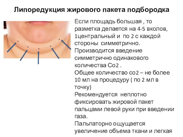 Липоредукция жирового пакета подбородка Если площадь большая , то разметка делается