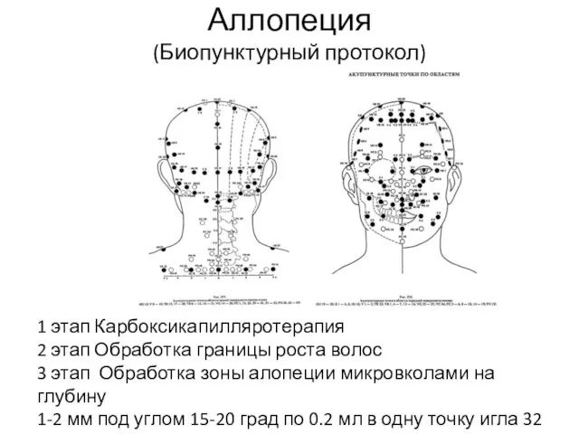 Аллопеция (Биопунктурный протокол) 1 этап Карбоксикапилляротерапия 2 этап Обработка границы роста