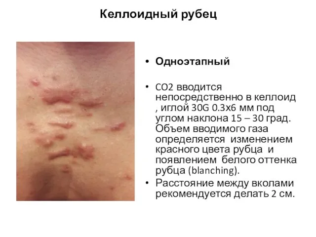 Келлоидный рубец Одноэтапный CO2 вводится непосредственно в келлоид , иглой 30G