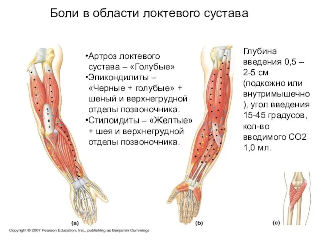 Боли в области локтевого сустава Артроз локтевого сустава – «Голубые» Эпикондилиты