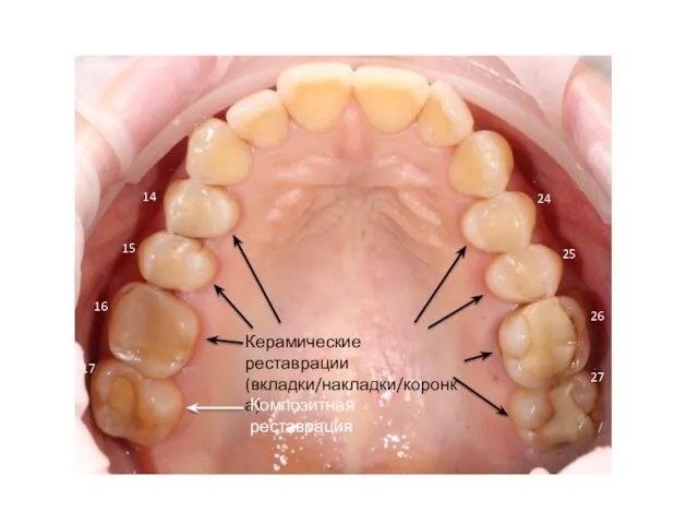 Керамические реставрации (вкладки/накладки/коронка) Композитная реставрация 17 16 15 14 24 25 26 27