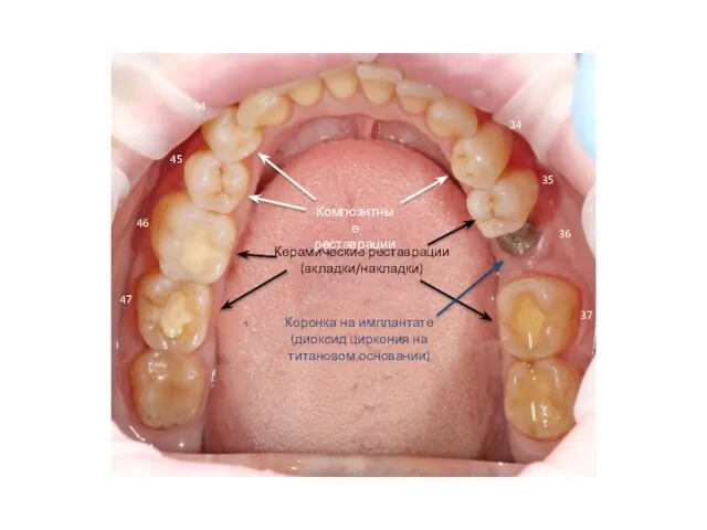 Керамические реставрации (вкладки/накладки) Композитные реставрации Коронка на имплантате (диоксид циркония на