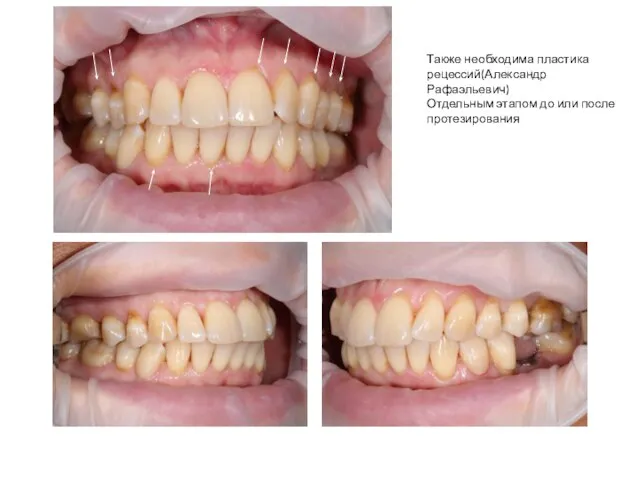 Также необходима пластика рецессий(Александр Рафаэльевич) Отдельным этапом до или после протезирования