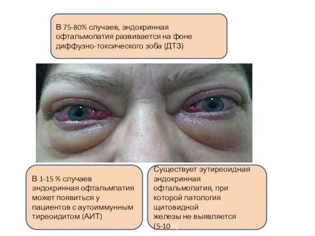 В 75-80% случаев, эндокринная офтальмопатия развивается на фоне диффузно-токсического зоба (ДТЗ)