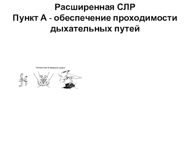 Расширенная СЛР Пункт А - обеспечение проходимости дыхательных путей