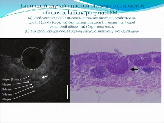 Типичный случай инвазии опухоли в слизистой оболочке lamina propria(LPM). (a) изображение