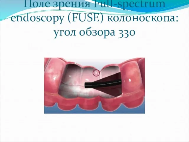 Поле зрения Full-spectrum endoscopy (FUSE) колоноскопа: угол обзора 330