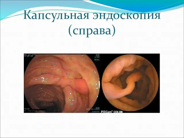 Капсульная эндоскопия(справа)