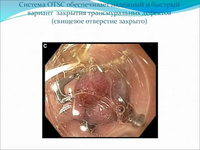 Система OTSC обеспечивает надежный и быстрый вариант закрытия трансмуральных дефектов (свищевое отверстие закрыто)