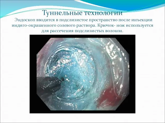 Туннельные технологии Эндоскоп вводится в подслизистое пространство после инъекции индиго-окрашенного солевого