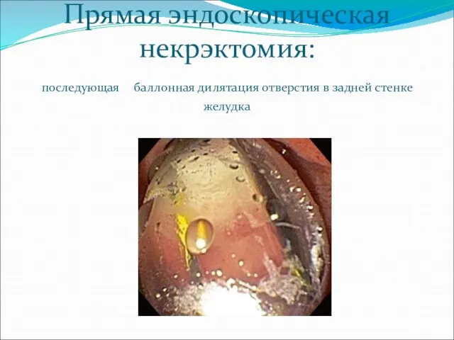 Прямая эндоскопическая некрэктомия: последующая баллонная дилятация отверстия в задней стенке желудка