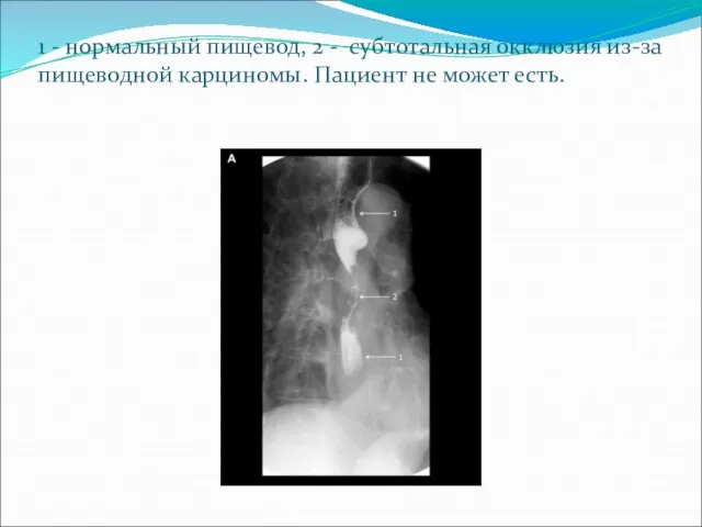 1 - нормальный пищевод, 2 - субтотальная окклюзия из-за пищеводной карциномы. Пациент не может есть.