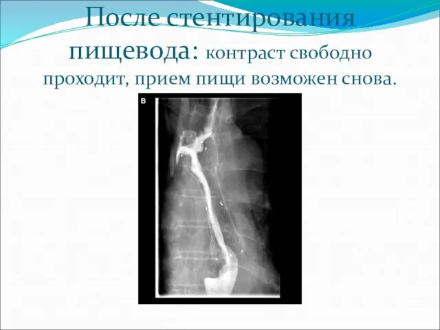 После стентирования пищевода: контраст свободно проходит, прием пищи возможен снова.