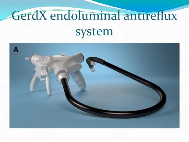 GerdX endoluminal antireflux system