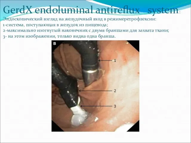 GerdX endoluminal antireflux system: Эндоскопический взгляд на желудочный вход в режимеретрофлексии: