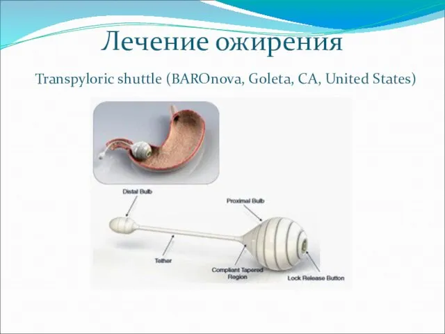 Лечение ожирения Transpyloric shuttle (BAROnova, Goleta, CA, United States)