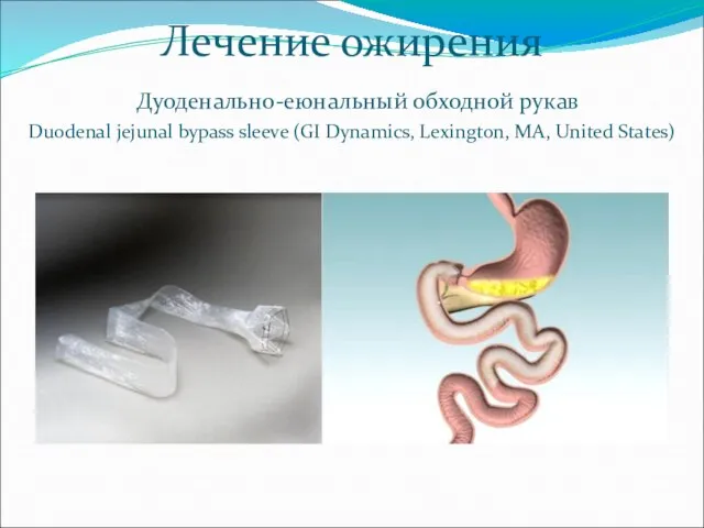 Лечение ожирения Дуоденально-еюнальный обходной рукав Duodenal jejunal bypass sleeve (GI Dynamics, Lexington, MA, United States)