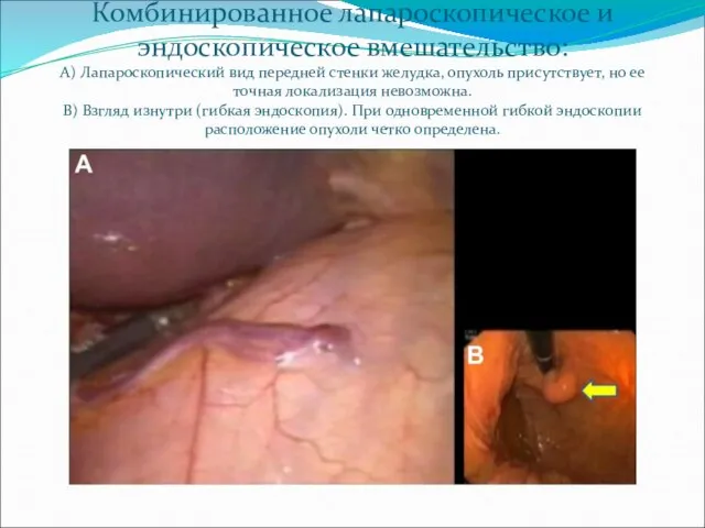 Комбинированное лапароскопическое и эндоскопическое вмешательство: A) Лапароскопический вид передней стенки желудка,