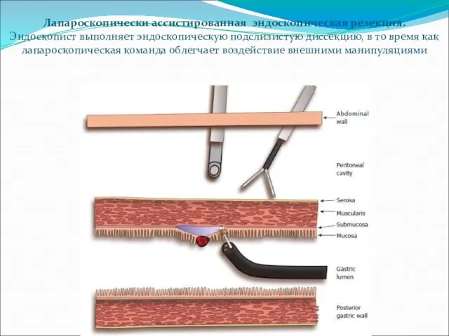 Лапароскопически ассистированная эндоскопическая резекция. Эндоскопист выполняет эндоскопическую подслизистую диссекцию, в то