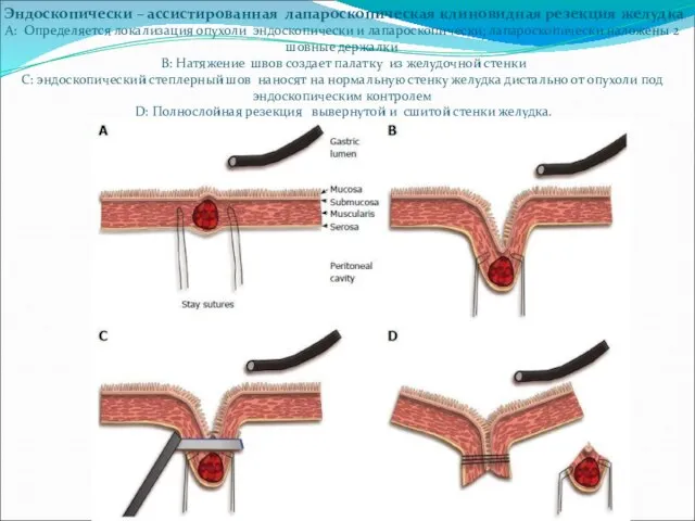 Эндоскопически – ассистированная лапароскопическая клиновидная резекция желудка А: Определяется локализация опухоли