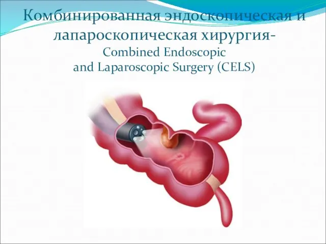 Комбинированная эндоскопическая и лапароскопическая хирургия- Combined Endoscopic and Laparoscopic Surgery (CELS)