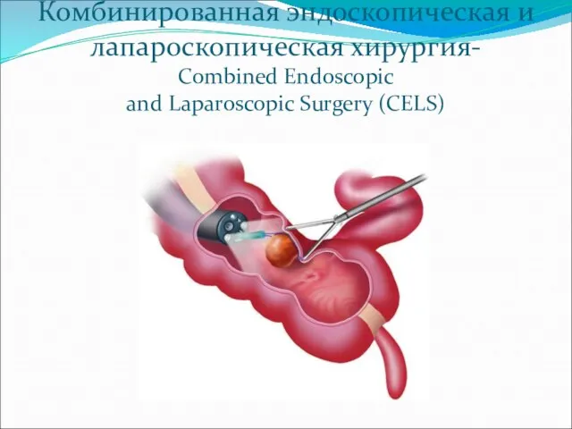 Комбинированная эндоскопическая и лапароскопическая хирургия- Combined Endoscopic and Laparoscopic Surgery (CELS)