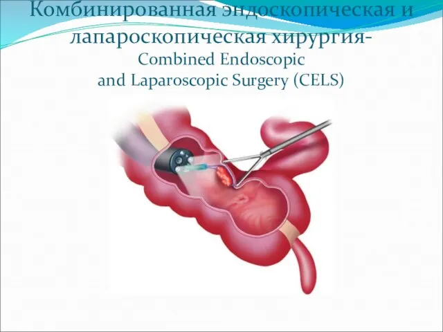 Комбинированная эндоскопическая и лапароскопическая хирургия- Combined Endoscopic and Laparoscopic Surgery (CELS)