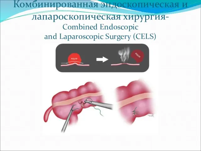 Комбинированная эндоскопическая и лапароскопическая хирургия- Combined Endoscopic and Laparoscopic Surgery (CELS)