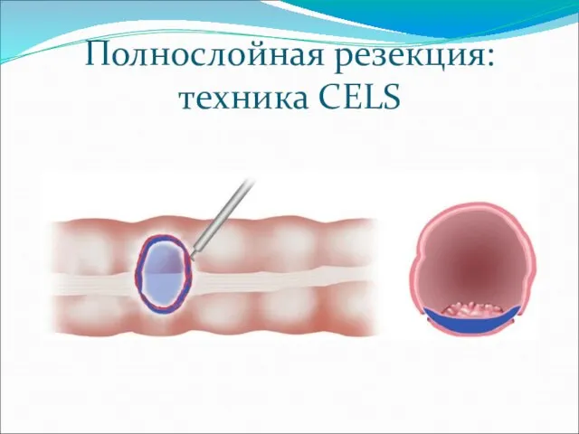 Полнослойная резекция: техника CELS