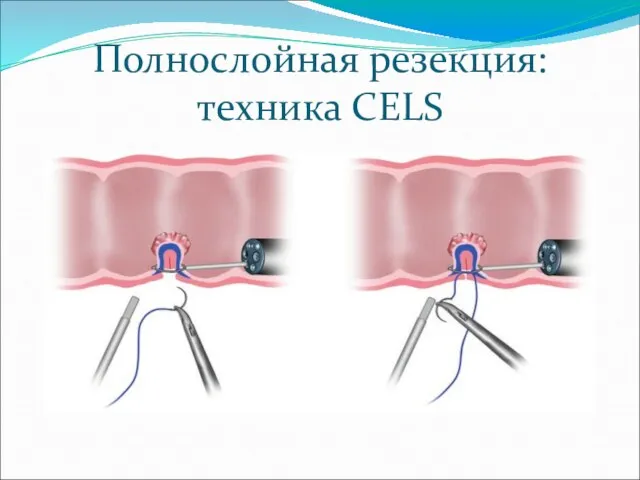 Полнослойная резекция: техника CELS